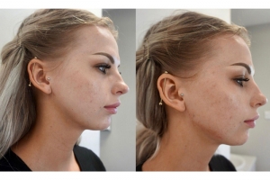 Enhancing Your Facial Features: The Benefits and Risks of Jawline and Cheek Fillers